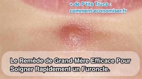 comment soigner un furoncle fessier|Furoncle fessier : causes, symptômes, diagnostic et traitements